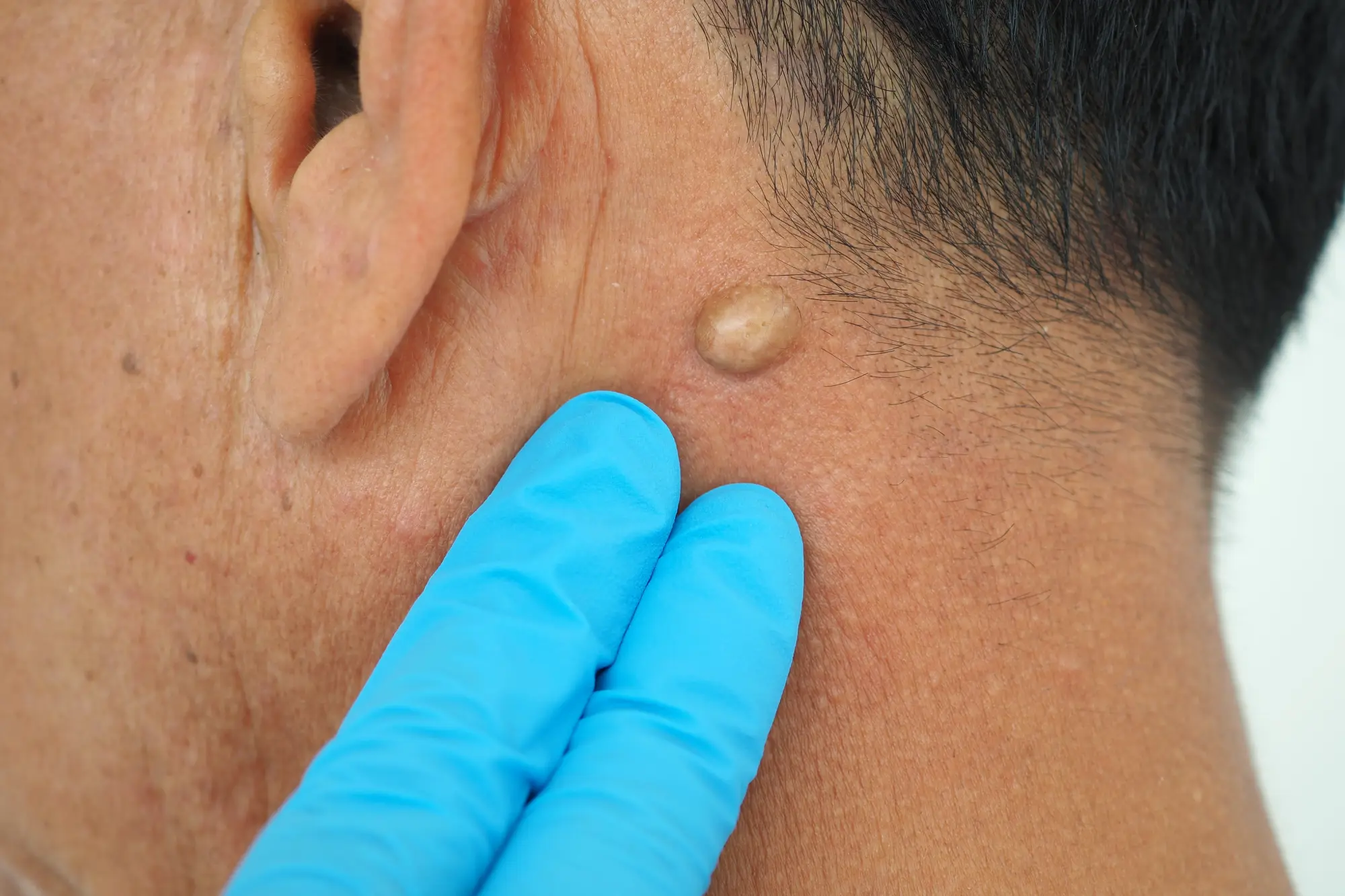 Client at Biltmore Dermatology getting treatment for a Cyst